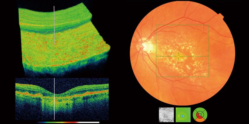 Optik Koherent Tomografi