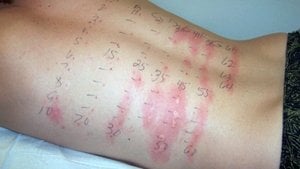 Hatalı Tıbbi Test Tercihi, Birçok Çocuğa Boş Yere "Gıda Alerjisi" Teşhisi Konmasına Neden Oluyor!