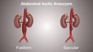 Study Links Abdominal Aortic Aneurysms To Systemic Vascular Enlargement