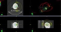 Dosimetric and radiobiological evaluation of stereotactic radiosurgery using volumetric modulated arc therapy and dynamic conformal arc therapy for multiple brain metastases - Scientific Reports