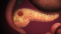 Sessiz İlerleyen Tehdit: Pankreas Başı Kanseri Hakkında Bilmeniz Gereken Her Şey