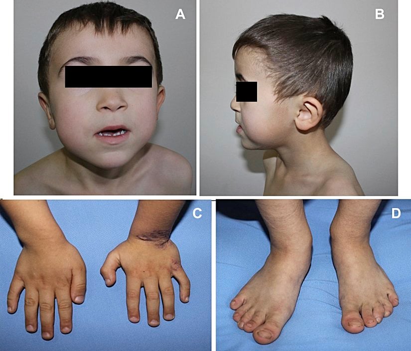 Fetal Valproate Syndrome