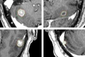 MRI Distortion Correction Enhances Control Of Brain Metastases Treatment