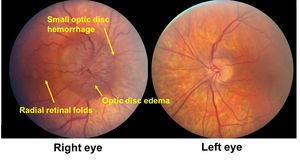 Understanding Changes To Optic Nerve Microvasculature After Hemorrhage