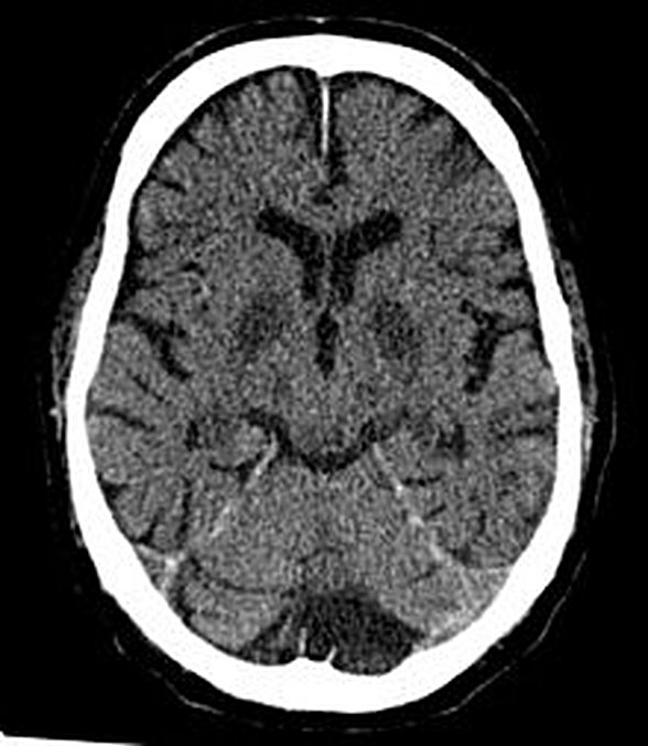 Hipoksiden sonra beyin B.T. (Tomografi) si