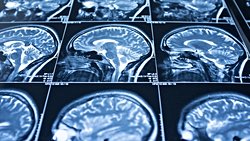 Dinlenik Beyinlerde Şizofreni İzleri Gözlenebiliyor!