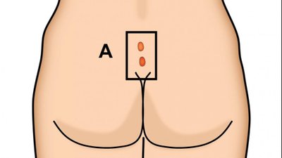Kuyruk Sokumunda Rahatsız Edici Kıl Dönmesi: Pilonidal Sinüs ve Pilonidal Apse