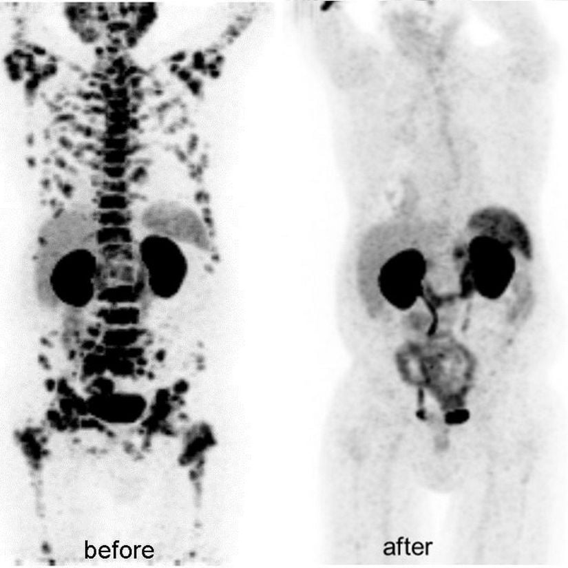 Metastaz yapmış prostat kanserine sahip bir hastanın, tedaviden önceki ve sonraki PET-CT taramaları.