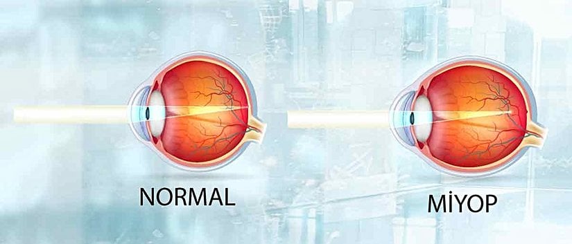 Miyop bir göz ile normal göz arasındaki fark.