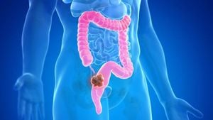 Novel Body Shape Index Reveals Colorectal Cancer Risks