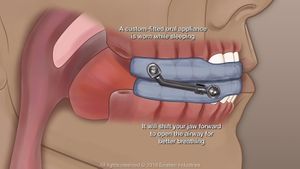 Innovative Dental Appliances Enhance Maxillary Growth And Parental Satisfaction