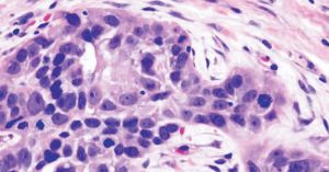 Eight-Month Delay For Histological Results Leads To Cancer Metastasis