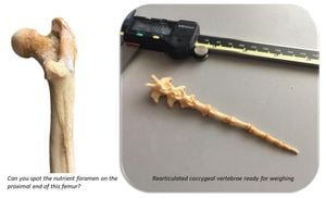 Study Reveals Anatomical Variations Of Humerus Nutrient Foraminal Structures