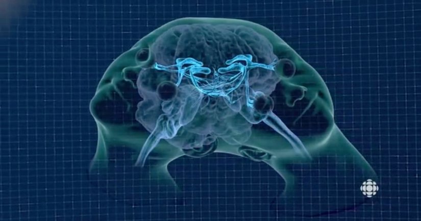 İkizlerin iki ayrı beyni vardır; ancak bu beyinler birbirinden ayrılamayacak şekilde bağlantılıdır. Bu bağlantıyı sağlayan parçaların bir kısmını oluşturan talamik köprü ve yaptığı bağlantılar fotoğrafta gözükmektedir.