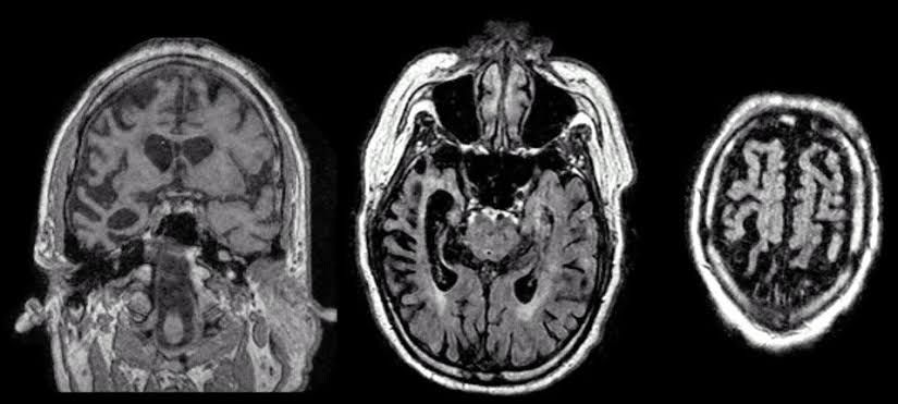 Fronto-temporal demans açısından frontal (ön) ve temporal (yan) loblarında gerçekleşen gözle görülür atrofi (küçülme).