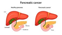 Pankreas Kanseri Nedir? Belirtileri Nelerdir? Tedavi Seçenekleri Nelerdir?