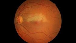 Santral Retinal Arter Tıkanıklığı Nedir? Belirtileri ve Tedavi Seçenekleri Nelerdir?