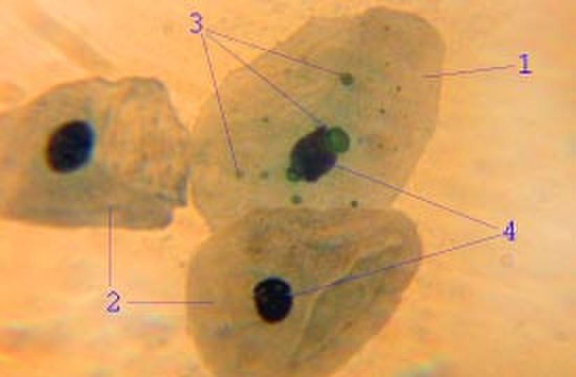 Epitel hücresinde chlamydia pneumoniae. Akut bronşit. Enfekte epitelyosit (1), Enfekte olmayan epiteliyositler (2), Hücredeki klamidyal inklüzyon cisimcikleri (3) ve hücre çekirdekleri (4).