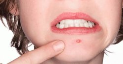 Sivilce oluşumunun kalıcı bir tedavisi var mı?