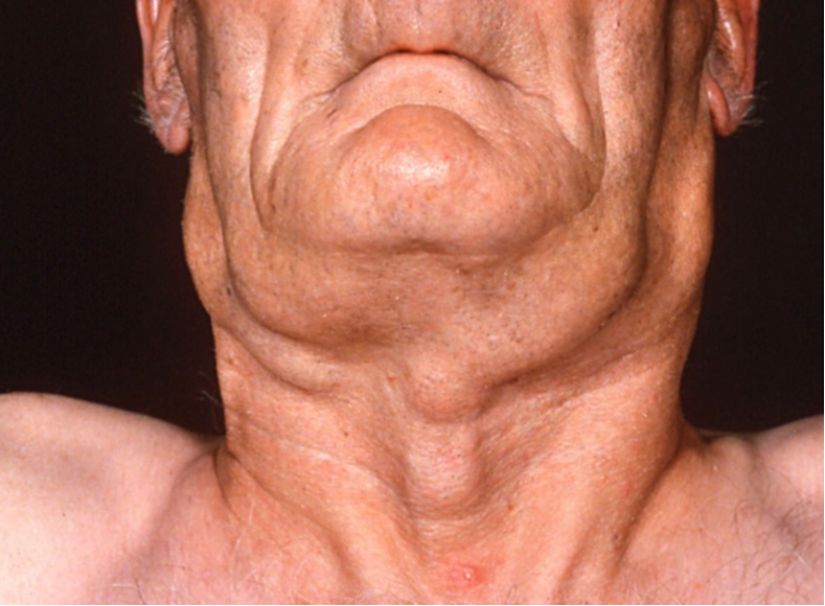 Non-Hodgkin Lenfoma