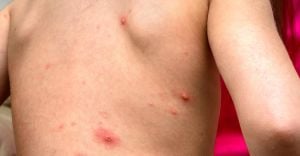 Mexico Issues Health Alert Amid Measles Spike