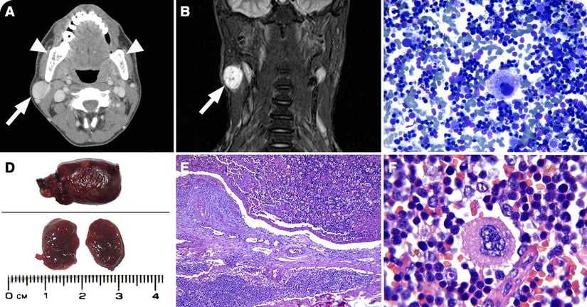 24 yaşında β-talasemi major hastasında yüz kemiklerinde ekstramedüller hematopoez nodları oluşumu.