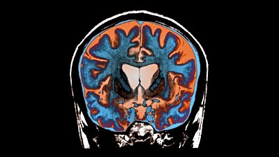 Deneysel Bir Tedavi İlk Kez Huntington Hastalığı’nın İlerlemesini Yavaşlattı!