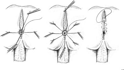 Anüssüz Doğan Bebekler: Bazı Doğumlarda Hekimler Anüsü Yapay Olarak Oluşturmak Zorunda Kalıyor!