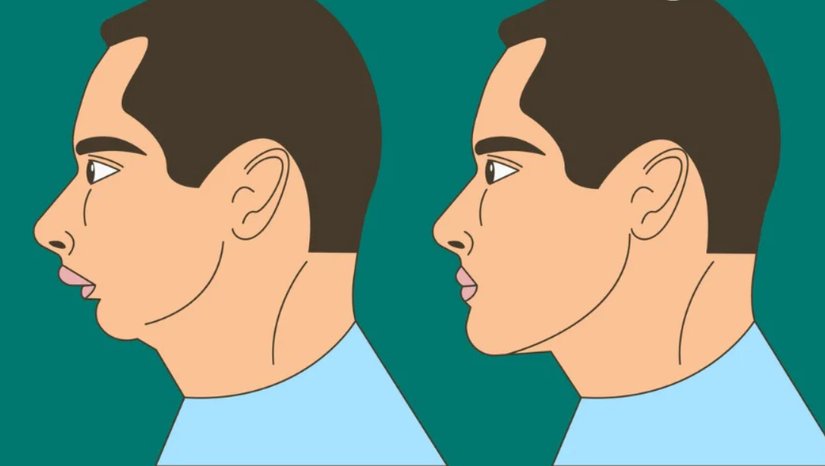 Mewing Nedir? Ameliyat Olmadan Estetik Bir Yüz Şekli Kazanmak Mümkün mü?