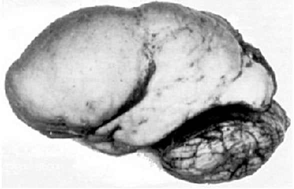 Bir Lissensefali hastasının beyni