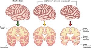 Recognizing Early Warning Signs Of Alzheimer's Disease