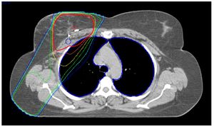 Promising Results For Breast Cancer Patients Using New Radiation Technique