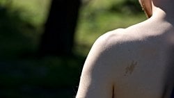 Birthmarks: From the Kiss of Angels to Port Wine Stains...