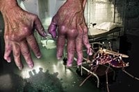 Cases of killer virus that makes the body ‘fold in on itself’ soaring in UK