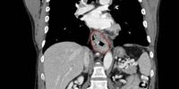 Active Surveillance vs Standard Surgery Post-Neoadjuvant Chemoradiotherapy for Esophageal Cancer | 2 Minute Medicine