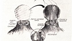 Kafa Nakli Gerçekten Mümkün mü?