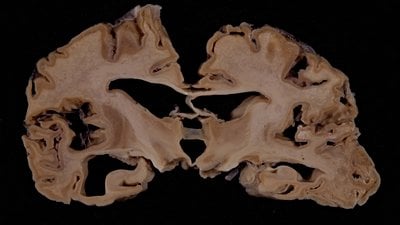 Creutzfeldt Jakob Hastalığı Nedir? Belirtileri ve Nedenleri Nelerdir?