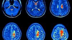 Beyin tümörü nedir?