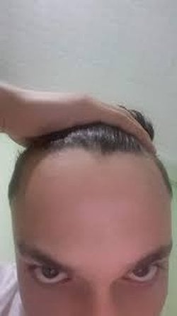 Saçlarımızın Dökülmesi Veya Genetik Olarak Alnı Açık İnsanlar Nasıl  Saçlara Sahip Olabilirler?