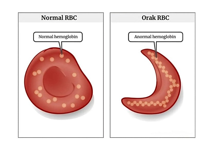 Şekil 22. Normal alyuvar ve Orak hücre alyuvarı. Şekilde gördüğünüz gibi hemoglobinler polimerleşerek uzun bir zincir oluşturmuştur. Bunun sonucu, hücre orak yapısı kazanmıştır.