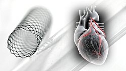 Stent mi Bypass mı? Kalp Hastalıklarında Hangi Tedavi Yöntemi Daha Etkili?