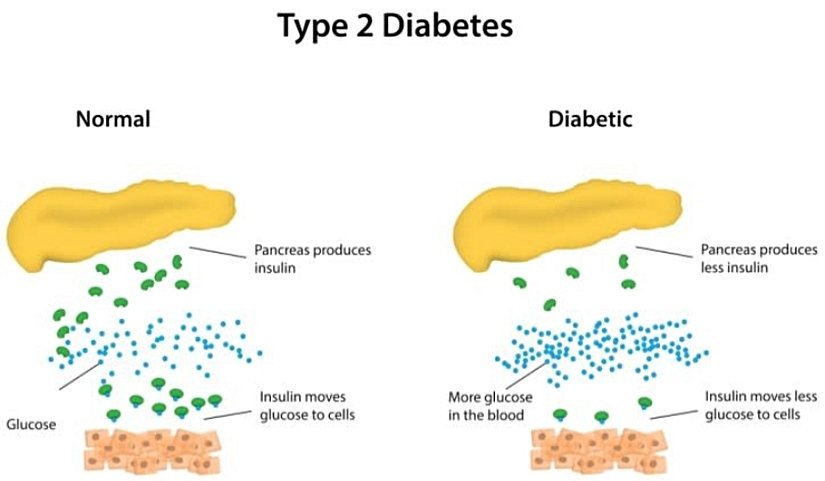 İnsülin direnci mekanizması