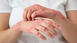 Atopik Dermatit(Egzama)Nedir?