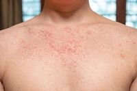 Urgent Health Alert: Contagious Measles Outbreak Escalates Across Western Australia