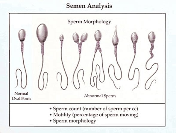 Sağlık ve saplıklık sperm şekilleri