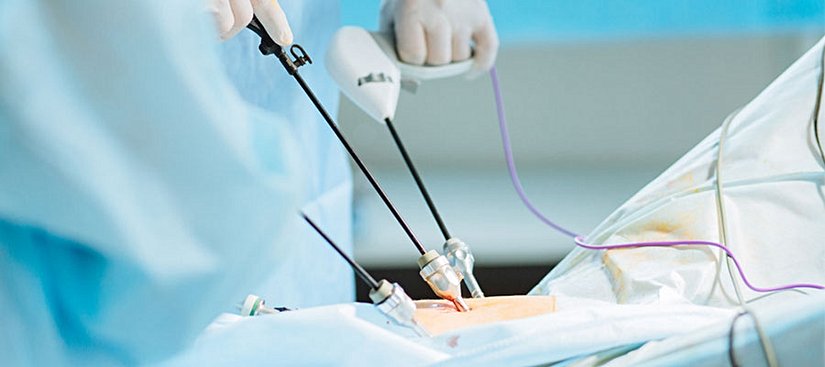 Ameliyat endoskopi sonrası karar veriliyor. Ameliyat kapalı olarak karında 5 adet delik açılarak robotik kollar yardımıyla karnın hava ile şişirilmesi sonunda gerçekleşiyor.