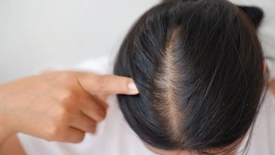 Saçların Dökülmesinin ve Beyazlamasının Nedeni Bir Proteinin Eksikliği Olabilir!