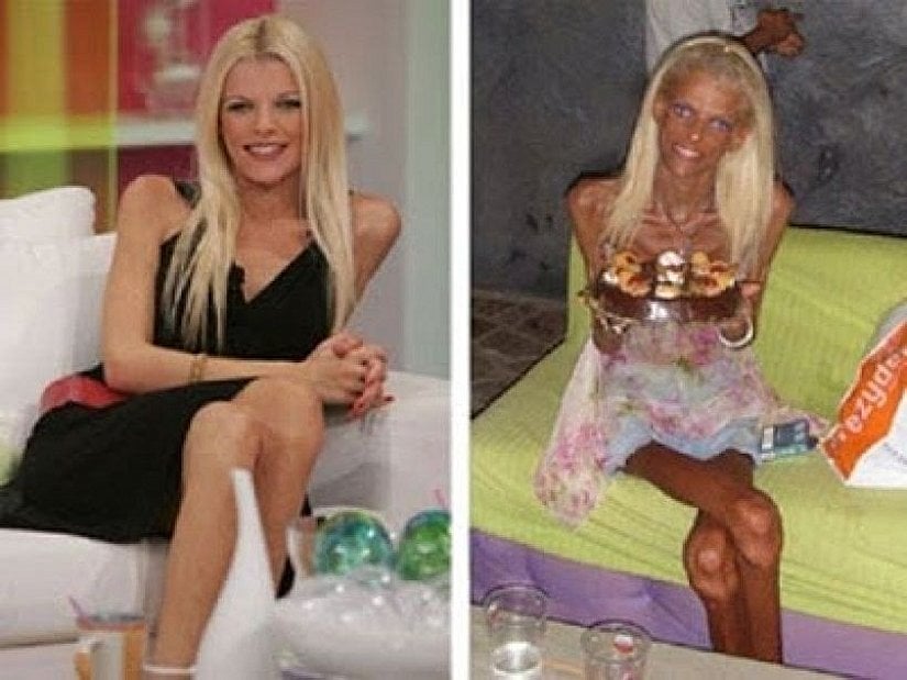 Görselde gördüğünüz iki kişi, aynı insan. Son zamanlarda internet haberlerinde sıklıkla gezinen Yunan gazeteci Nana Karagiannis Annita. Gazetecilikte güzelliği ile ses getirdikten sonra mankenliğe başlayan Annita, kısa sürede "daha zayıf olarak daha güzel olabileceğini" düşünerek anoreksiya bataklığına sürüklenmiştir. Hastalık onu görseldeki hale getirmiştir.