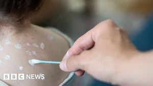 NHS To Launch Free Chickenpox Vaccine Nationwide In 2026