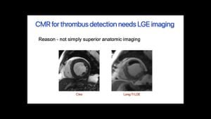 Study Links Left Atrial Dysfunction To Thrombus After Lobectomy